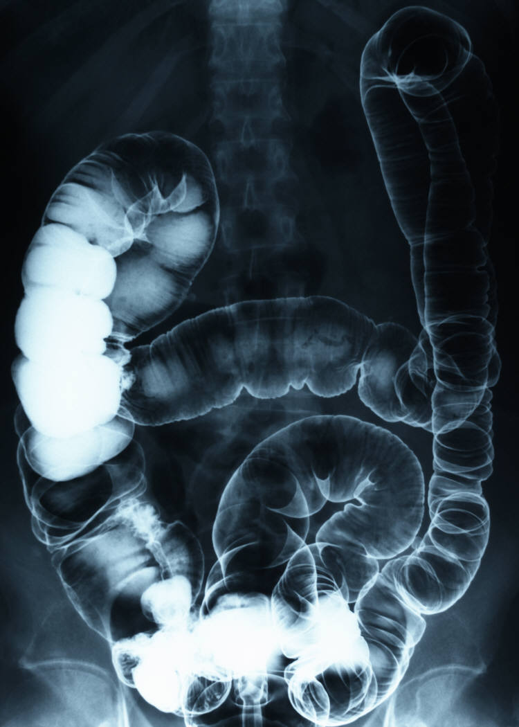 colon_intestines_xray_photo_nyreblog_com_.JPG