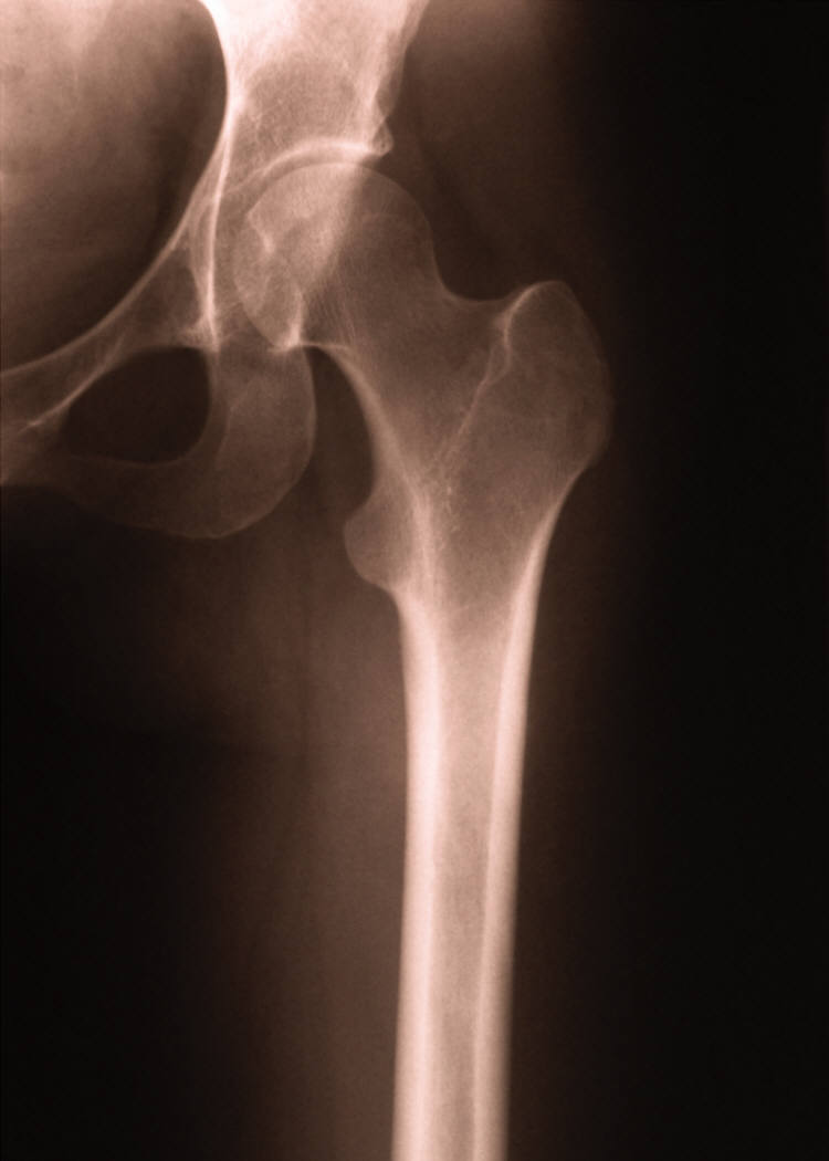 fractured_bone_x-ray_photo_nyreblog_com_.JPG