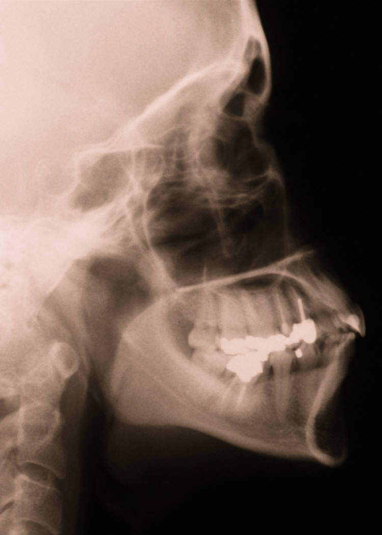 jaw_xray_nyreblog_com_.JPG